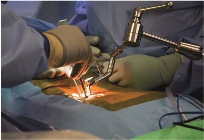 Surgery for Spine