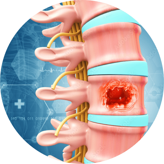 Spine Tumour