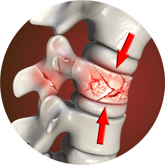 Spine fractures-ser