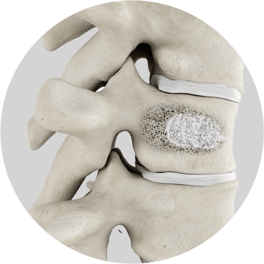 Vertebroplasty