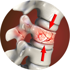 Spine fractures