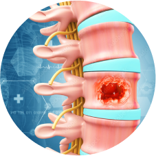 Spine Tumour